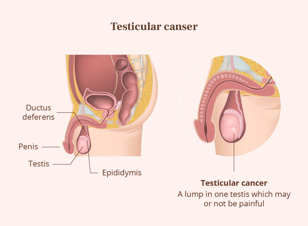 Know more about Cancer of the male reproductive system